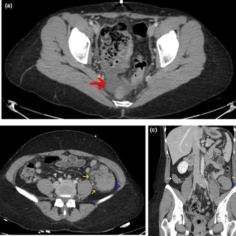 ovarian torsion blood tests|ovarian torsion after hysterectomy.